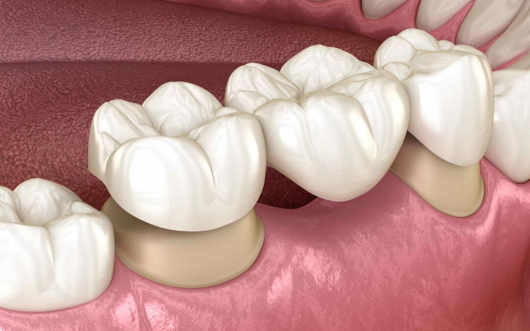 Dental Bridge Cost: What to Expect and Price Factors